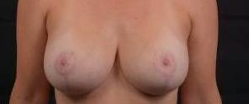 Breast Augmentation Mastopexy Before & After Gallery - Patient 635775 - Image 2