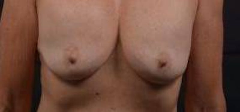 Breast Augmentation Mastopexy Before & After Gallery - Patient 355673 - Image 1