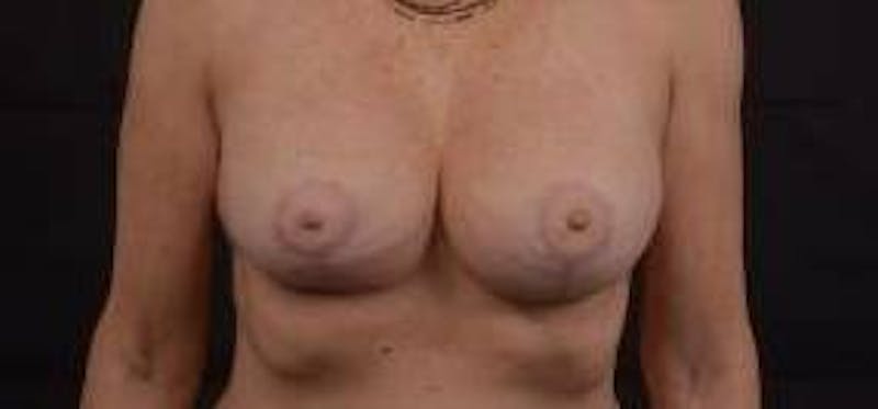 Breast Augmentation Mastopexy Before & After Gallery - Patient 355673 - Image 2