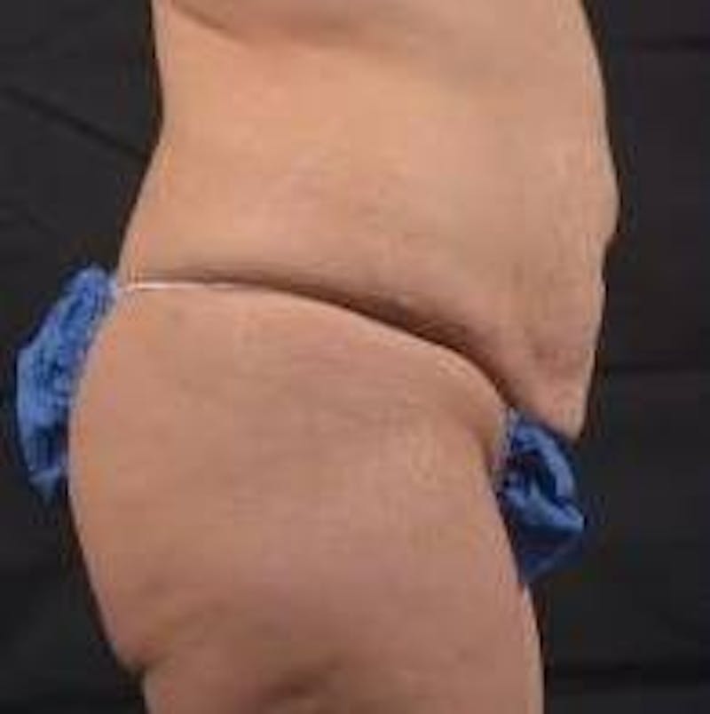 Breast Augmentation Mastopexy Before & After Gallery - Patient 411709 - Image 5