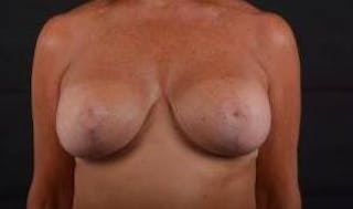 Breast Augmentation Mastopexy Before & After Gallery - Patient 787356 - Image 2