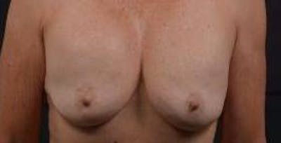 Breast Augmentation Mastopexy Before & After Gallery - Patient 124067 - Image 1