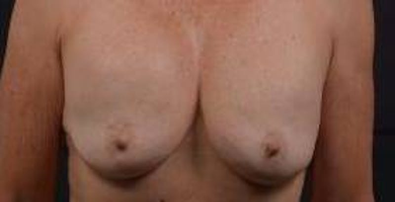 Breast Augmentation Mastopexy Before & After Gallery - Patient 124067 - Image 1
