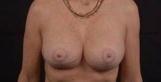 Breast Augmentation Mastopexy Before & After Gallery - Patient 124067 - Image 2