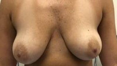 Breast Augmentation Mastopexy Before & After Gallery - Patient 983492 - Image 1