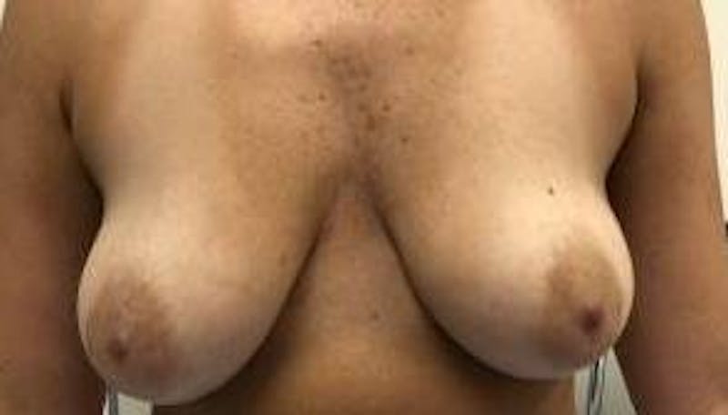 Breast Augmentation Mastopexy Before & After Gallery - Patient 983492 - Image 1