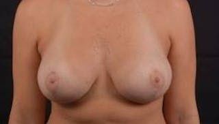 Breast Augmentation Mastopexy Before & After Gallery - Patient 983492 - Image 2