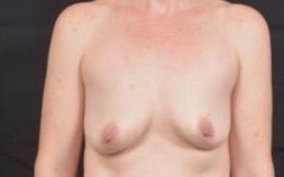 Breast Augmentation Mastopexy Before & After Gallery - Patient 246646 - Image 1