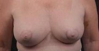 Breast Augmentation Mastopexy Before & After Gallery - Patient 759950 - Image 2