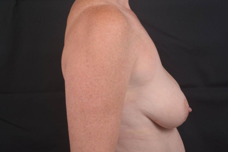 Breast Augmentation Mastopexy Before & After Gallery - Patient 911851 - Image 5