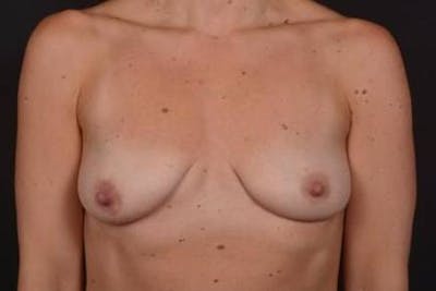 Breast Augmentation Mastopexy Before & After Gallery - Patient 301844 - Image 1