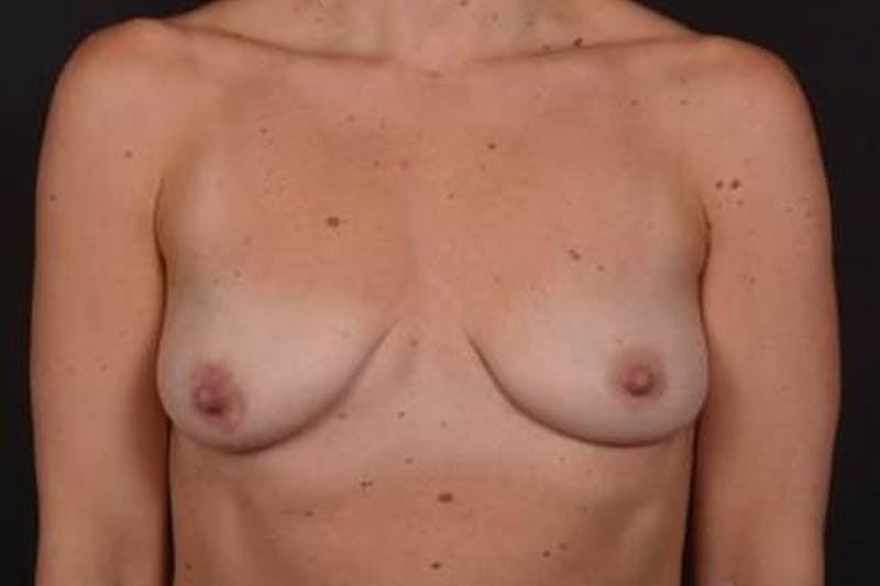 Breast Augmentation Mastopexy Before & After Gallery - Patient 301844 - Image 1