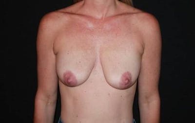 Breast Augmentation Mastopexy Before & After Gallery - Patient 432382 - Image 1