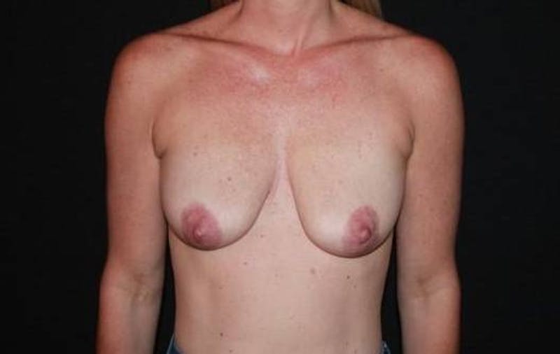 Breast Augmentation Mastopexy Before & After Gallery - Patient 432382 - Image 1