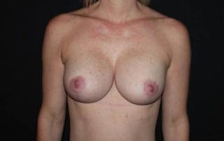 Breast Augmentation Mastopexy Before & After Gallery - Patient 432382 - Image 2