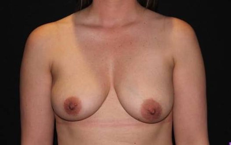 Breast Augmentation Mastopexy Before & After Gallery - Patient 378581 - Image 1