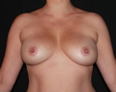 Breast Augmentation Mastopexy Before & After Gallery - Patient 164036 - Image 1