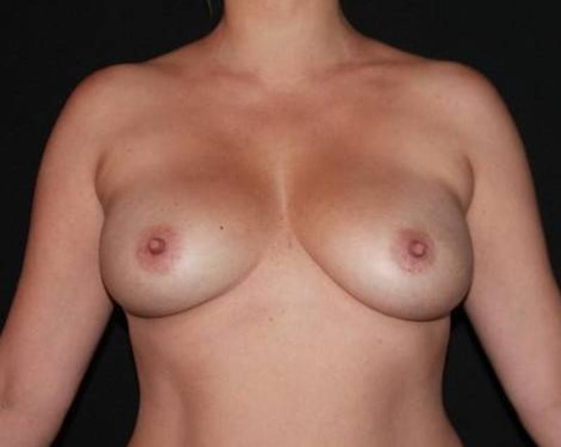 Breast Augmentation Mastopexy Before & After Gallery - Patient 164036 - Image 1