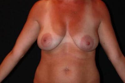 Breast Augmentation Mastopexy Before & After Gallery - Patient 123445 - Image 1