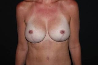 Breast Augmentation Mastopexy Before & After Gallery - Patient 123445 - Image 2