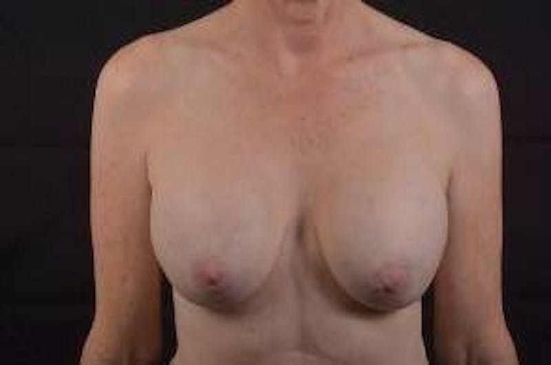 Breast Augmentation Mastopexy Before & After Gallery - Patient 206043 - Image 1