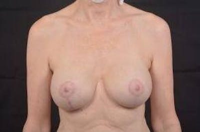 Breast Augmentation Mastopexy Before & After Gallery - Patient 206043 - Image 2