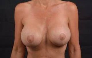Breast Augmentation Mastopexy Before & After Gallery - Patient 246497 - Image 2