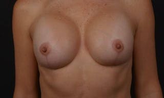 Breast Augmentation Mastopexy Before & After Gallery - Patient 282812 - Image 2