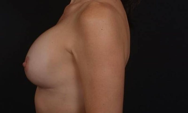 Breast Augmentation Mastopexy Before & After Gallery - Patient 282812 - Image 4