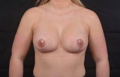 Breast Augmentation Mastopexy Before & After Gallery - Patient 330924 - Image 2