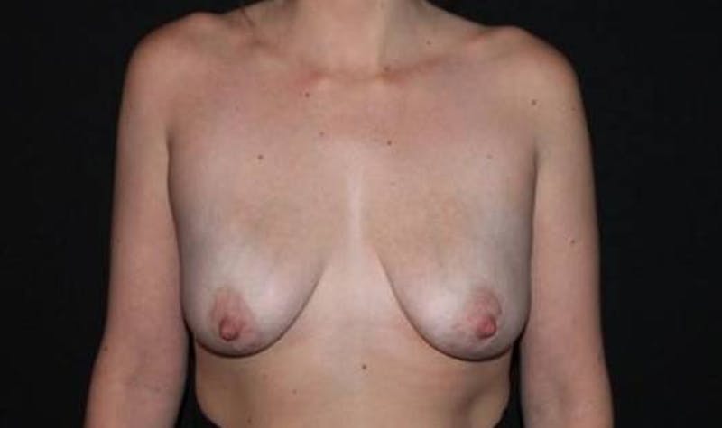 Breast Augmentation Mastopexy Before & After Gallery - Patient 186243 - Image 1
