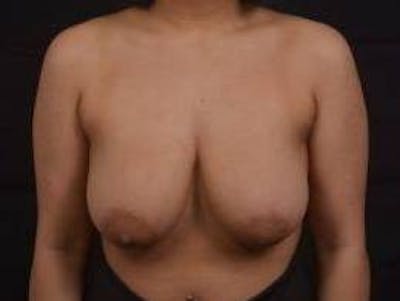 Breast Reduction Before & After Gallery - Patient 364401 - Image 1