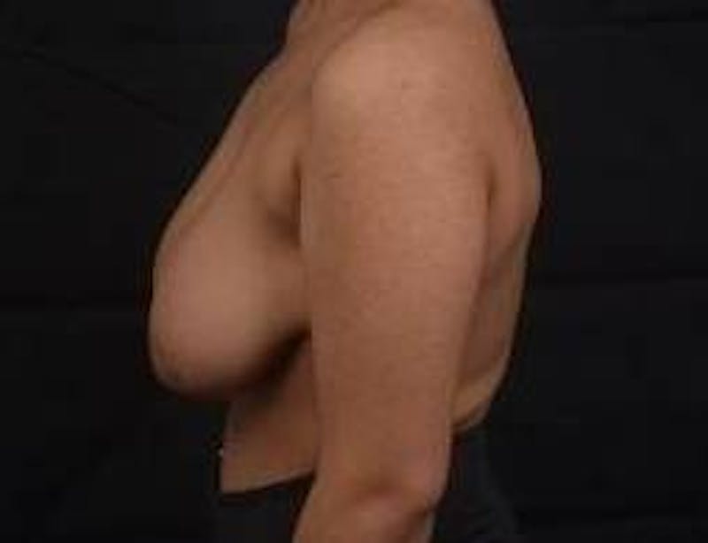 Breast Reduction Before & After Gallery - Patient 364401 - Image 3