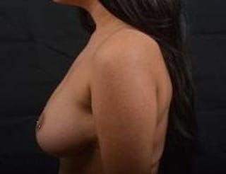 Breast Reduction Before & After Gallery - Patient 364401 - Image 4
