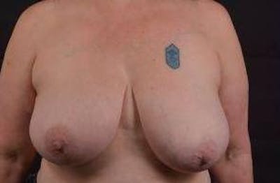 Breast Reduction Before & After Gallery - Patient 171362 - Image 1