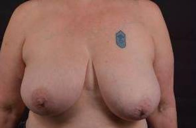 Breast Reduction Before & After Gallery - Patient 171362 - Image 1