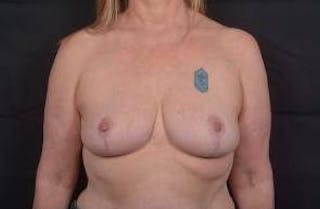 Breast Reduction Before & After Gallery - Patient 171362 - Image 2