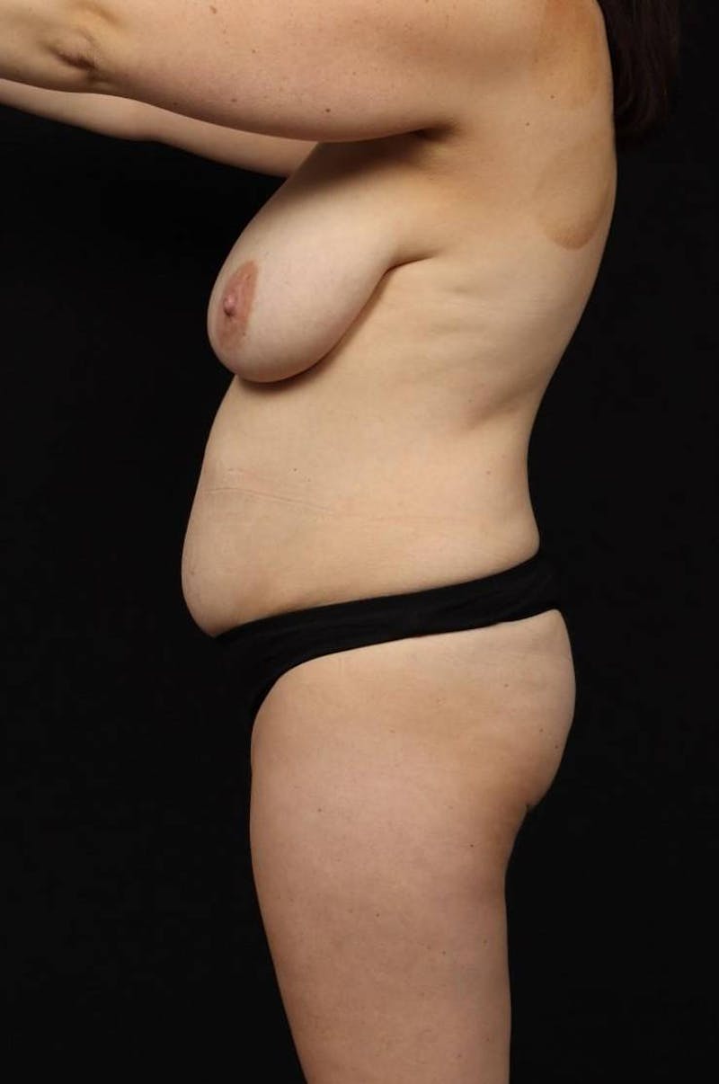 Breast Reduction Before & After Gallery - Patient 131811 - Image 5