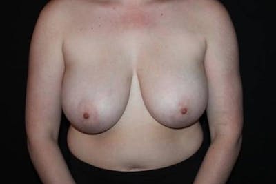 Breast Reduction Before & After Gallery - Patient 284685 - Image 1