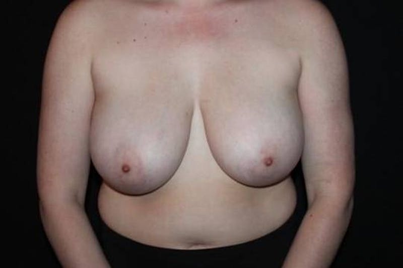 Breast Reduction Before & After Gallery - Patient 284685 - Image 1