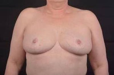 Breast Reduction Before & After Gallery - Patient 161821 - Image 2