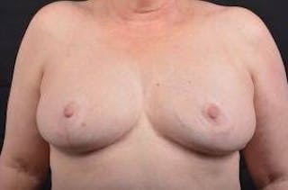 Breast Reduction Before & After Gallery - Patient 761967 - Image 2