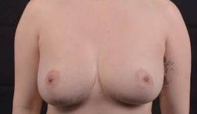 Breast Reduction Before & After Gallery - Patient 303669 - Image 1