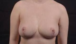 Breast Reduction Before & After Gallery - Patient 303669 - Image 2