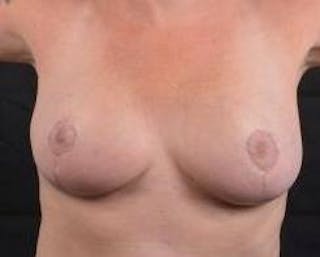 Breast Reduction Before & After Gallery - Patient 187058 - Image 2