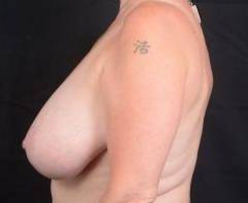 Breast Reduction Before & After Gallery - Patient 187058 - Image 3