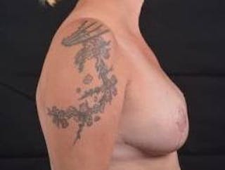 Breast Reduction Before & After Gallery - Patient 187058 - Image 6