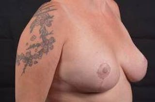 Breast Reduction Before & After Gallery - Patient 187058 - Image 10