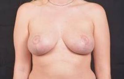 Breast Reduction Before & After Gallery - Patient 296512 - Image 2