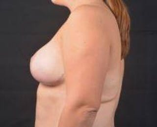 Breast Reduction Before & After Gallery - Patient 351277 - Image 4
